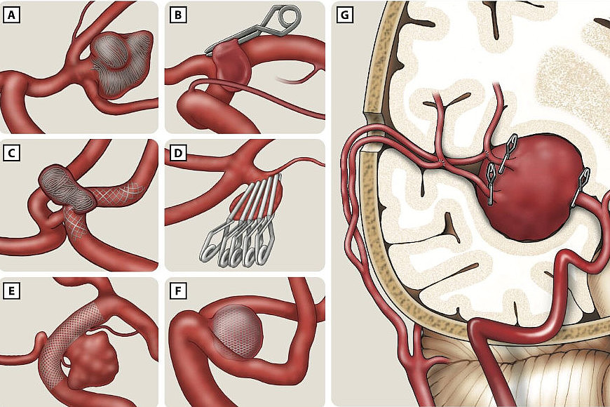 Behandlungsverfahren bei Aneurysmen, genauere Beschreibung am Textende